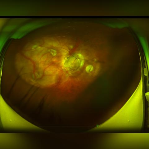 眼球震颤治疗新进展与研究综述