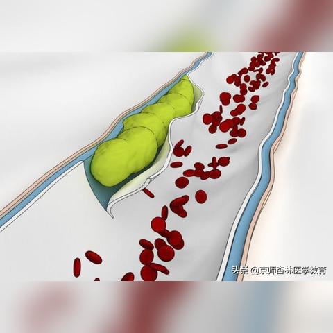 脑血栓最新治疗技术与方法研究